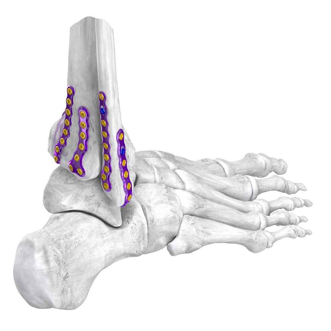 Gorilla® Ankle Fracture Plating System