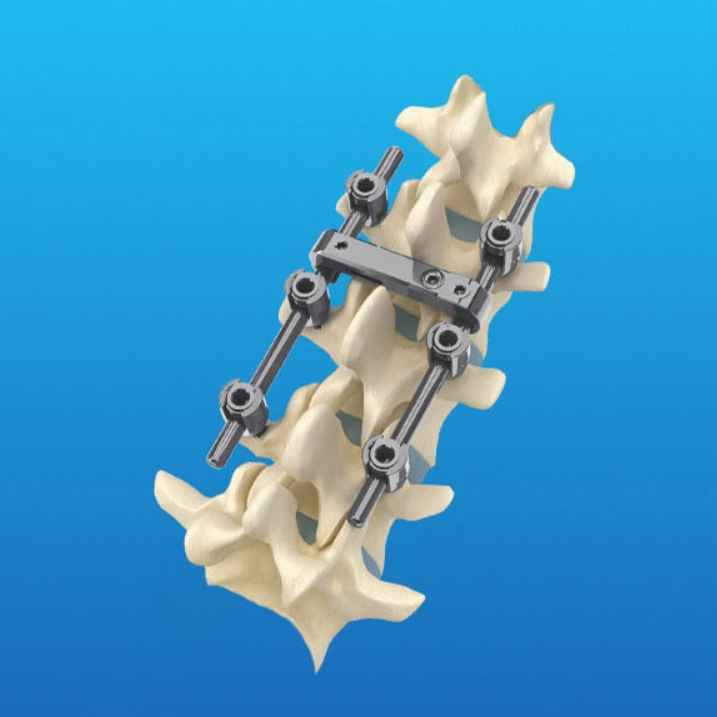 Pedicle Screw (MS-I)™ Spinal Fixation System