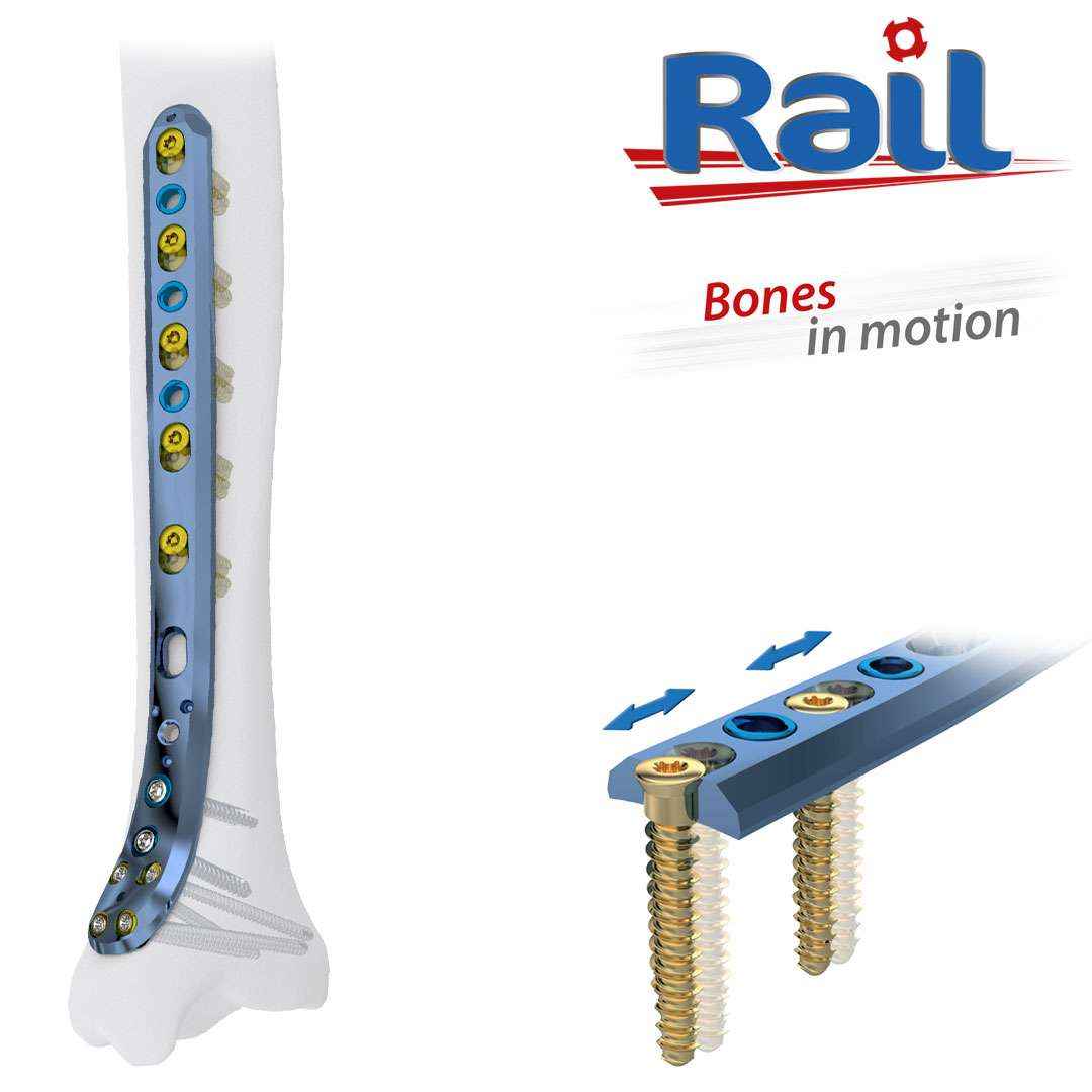 DTM Medial Distal Tibia plate