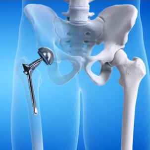 Custom Hip